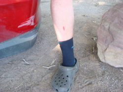Damaged Car and Leg A hole in my leg (and the car)